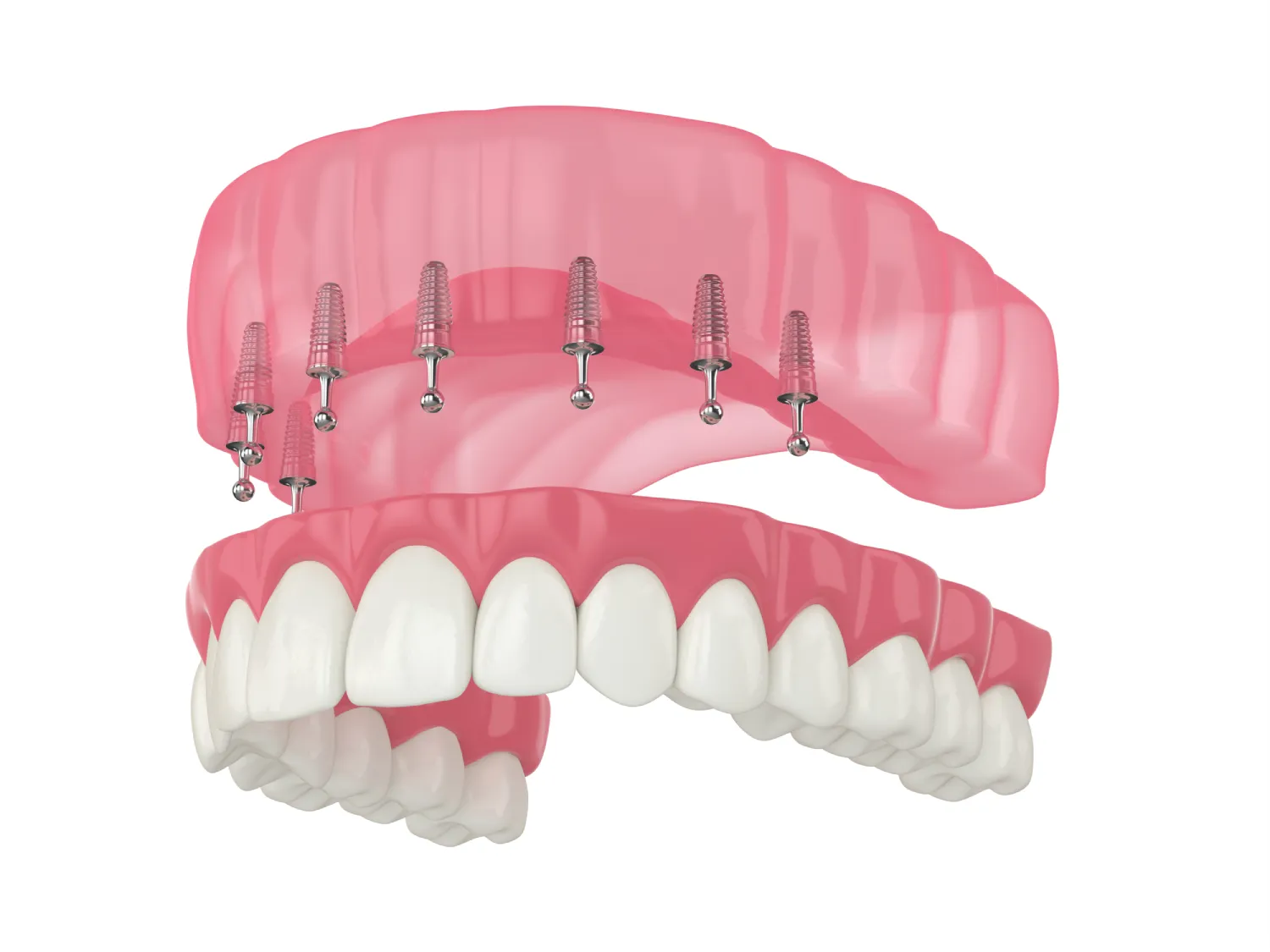 Implant Overdentures