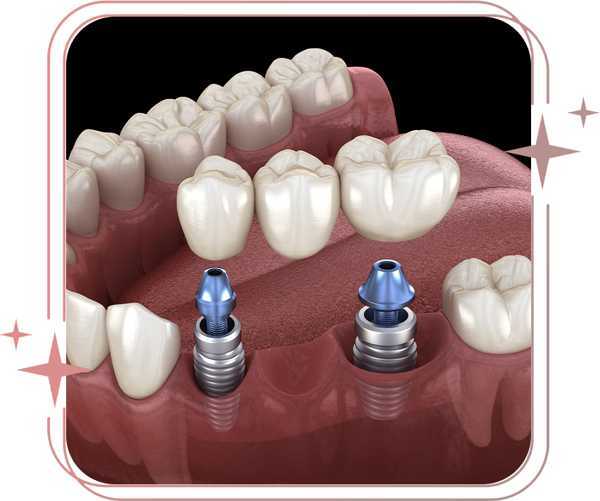 dental bridge
