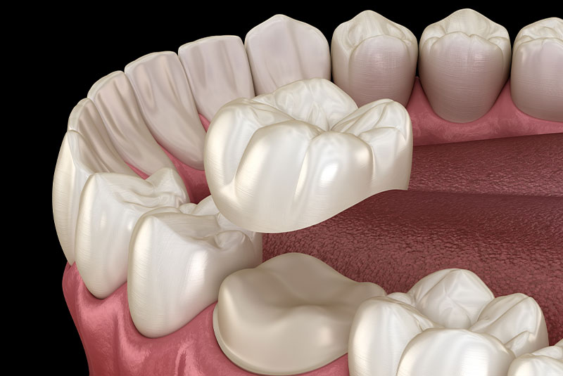 dental crown 3d