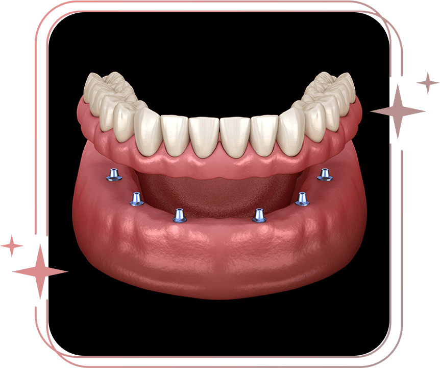 implant denture