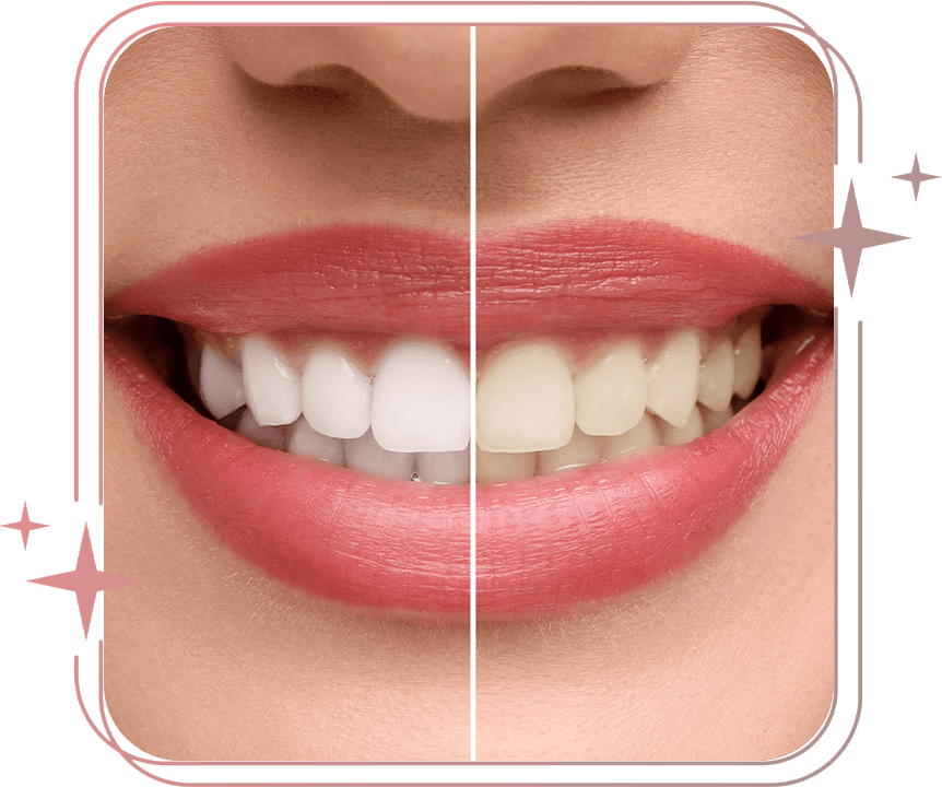 before after teeth whitening