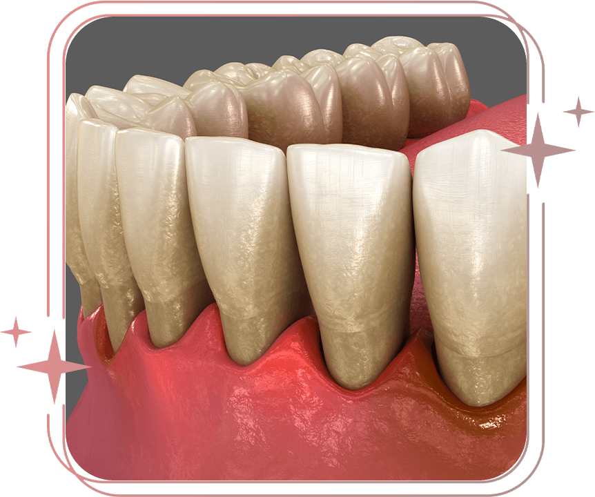 gum recession graphic