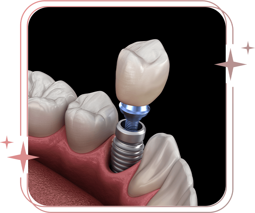 single dental implant